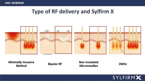 [WEBINAR] Dual Wave Technology in SYLFIRM X by Dr. Jinah Yoo.